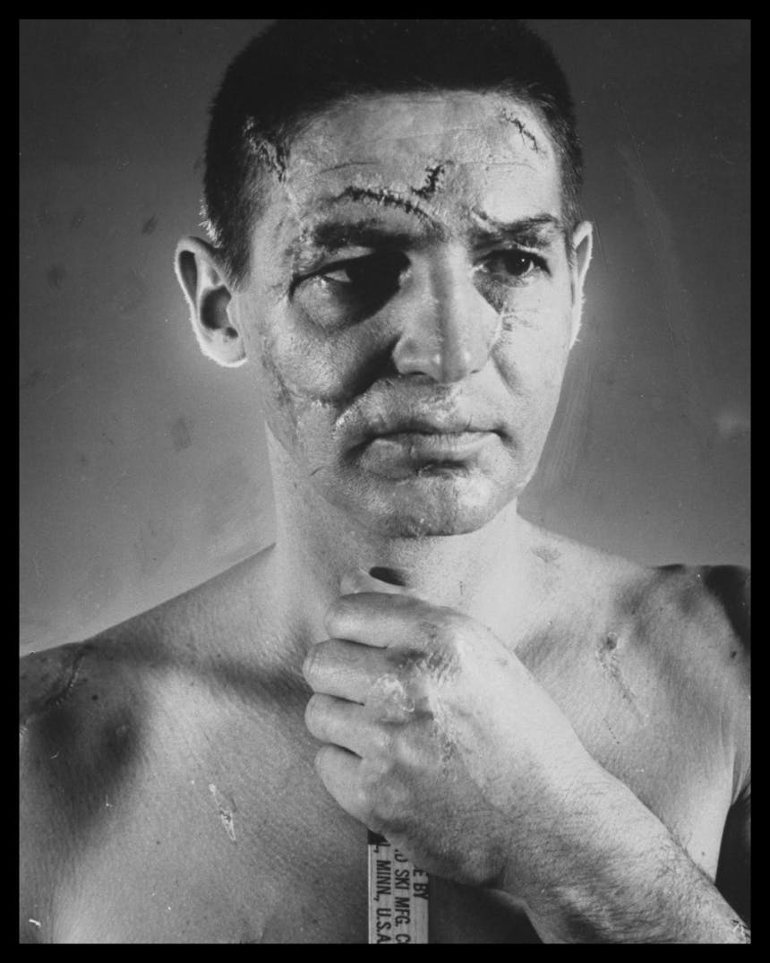 Hockey player Terry Sawchuk's face covered with scars